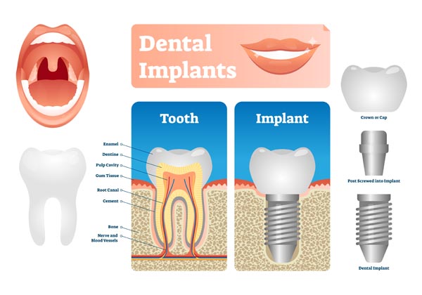 What Are Dental Implants And How Can They Replace Missing Teeth?