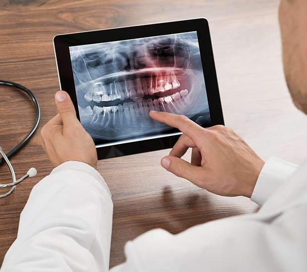 Stamford Types of Dental Root Fractures
